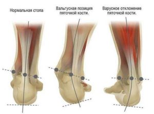 Вальгусная стопа