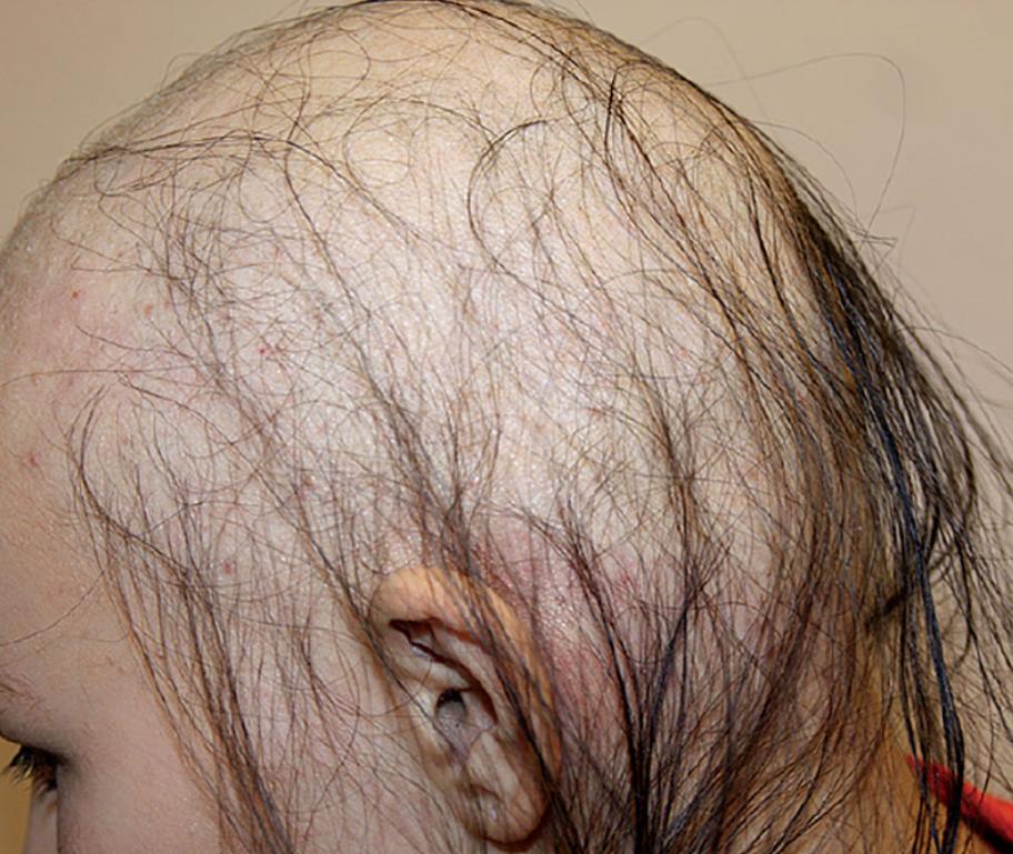 Выпадают волосы? Выпадение волос (Алопеция, облысение) у мужчин и женщин. Виды, причины и способы профилактики и лечения..
