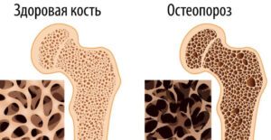 Профилактика и лечение остеопороза.