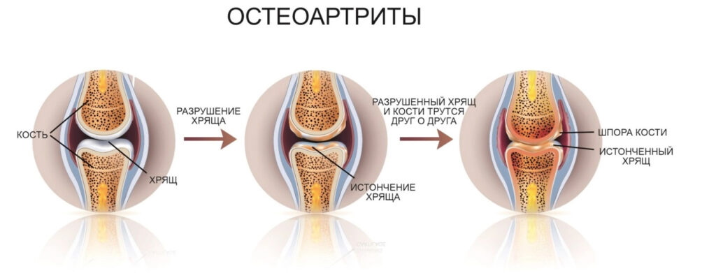 Остеоартроз и другие заболевания суставов. Причины остеоартрита, симптомы и лечение.