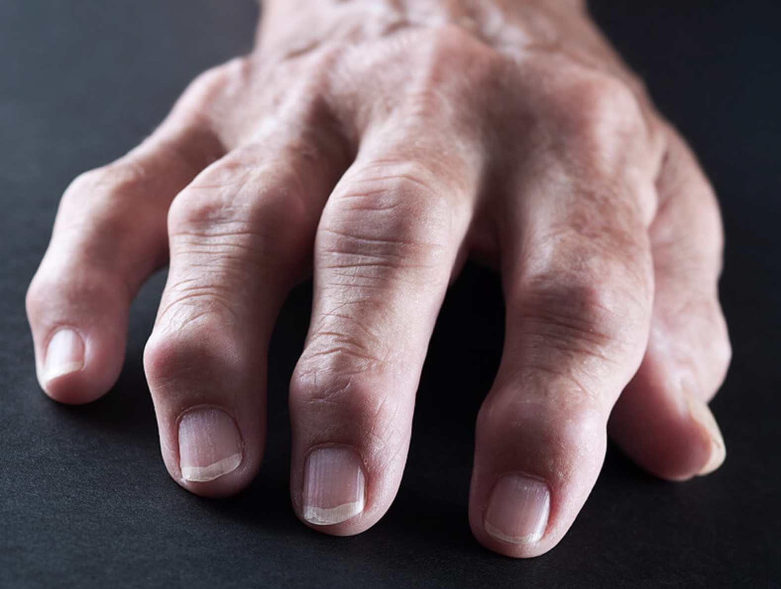 Артрит болезнь суставов. Ревматоидный артрит руки. Ревматоидный артрит пальцы.