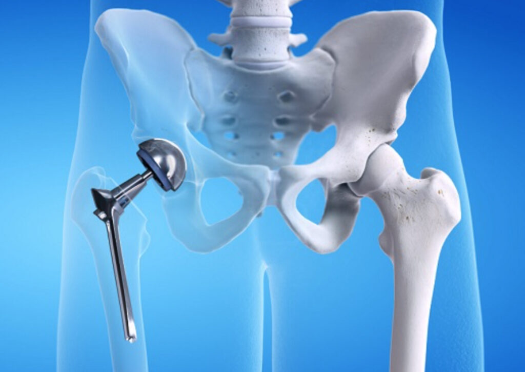 Искусственные суставы: технологии и методы замены суставов, такие как эндопротезирование и артроскопия.