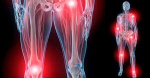 Болезни суставов: ревматоидный артрит, подагра, артроз и другие заболевания суставов.