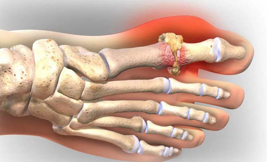 Болезни суставов: ревматоидный артрит, подагра, артроз и другие заболевания суставов.