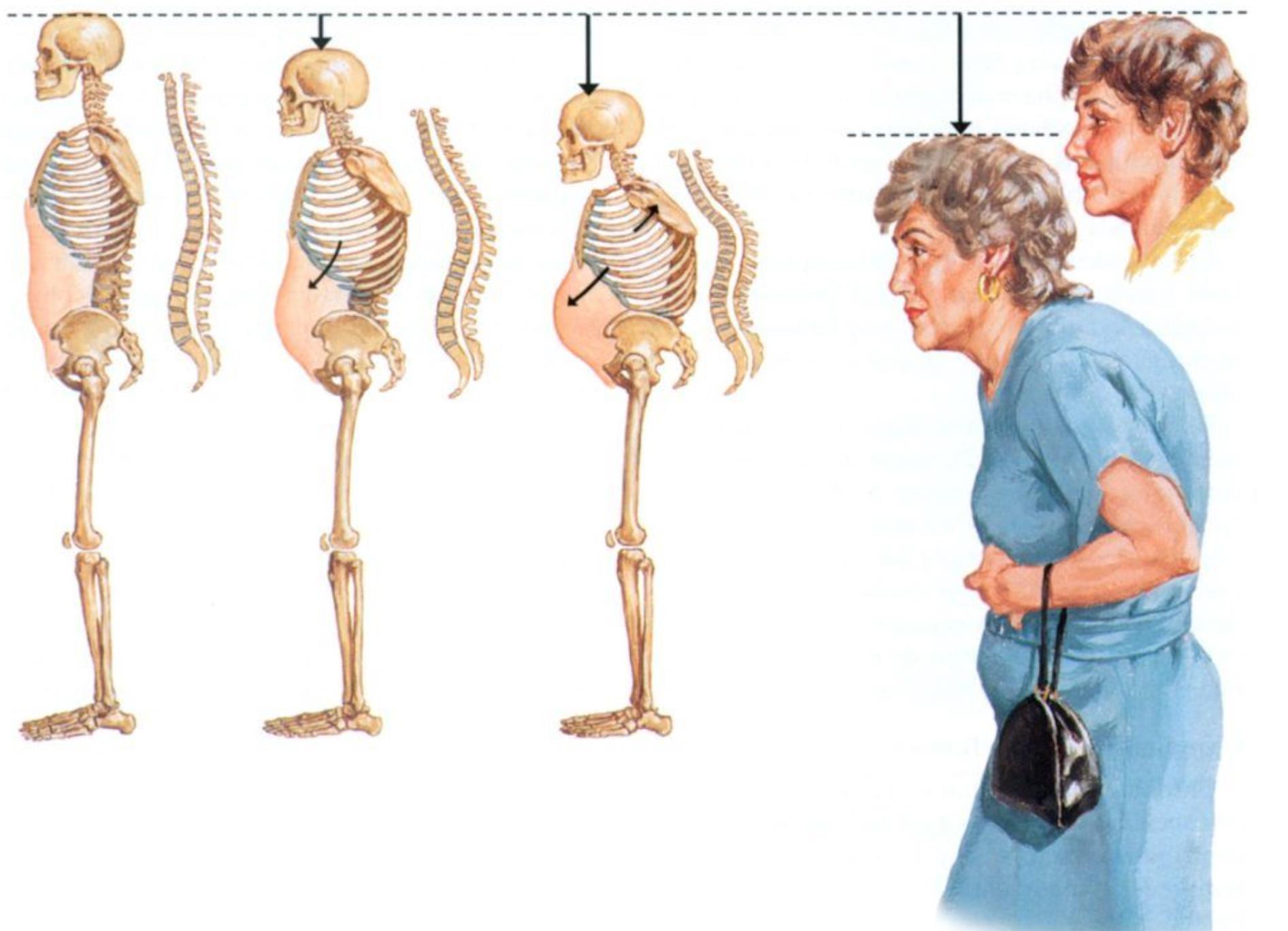 Тело человека растет растет. Скелет горбатого человека. Искривление позвоночника при остеопорозе у женщин. Возрастные изменения позвоночника.